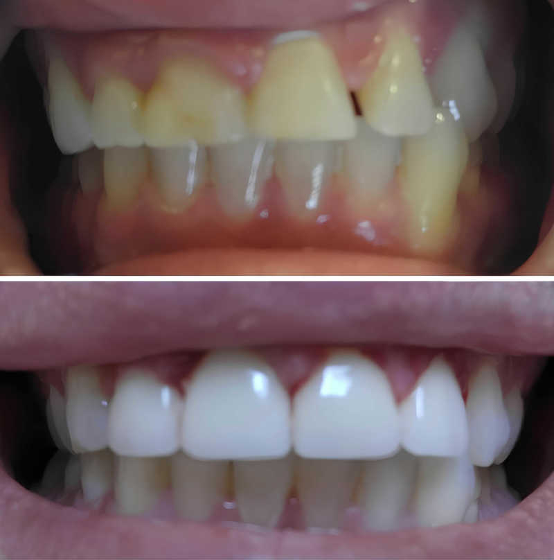 Before and After