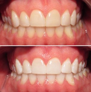 Before and After